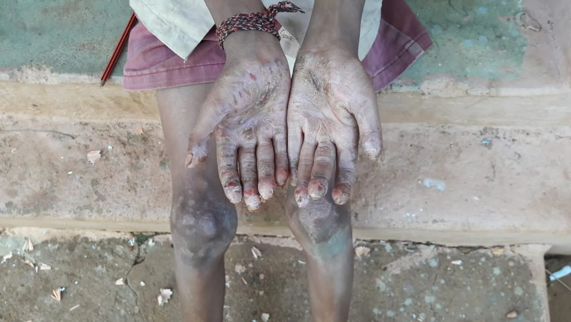 Strange disease